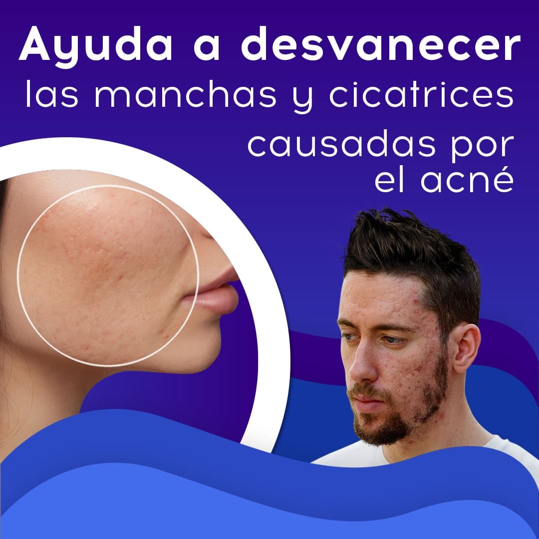 🤩COMPRA 1 LLEVA 2 🎁 CREMA ANTIÁCNE BIOAQUA